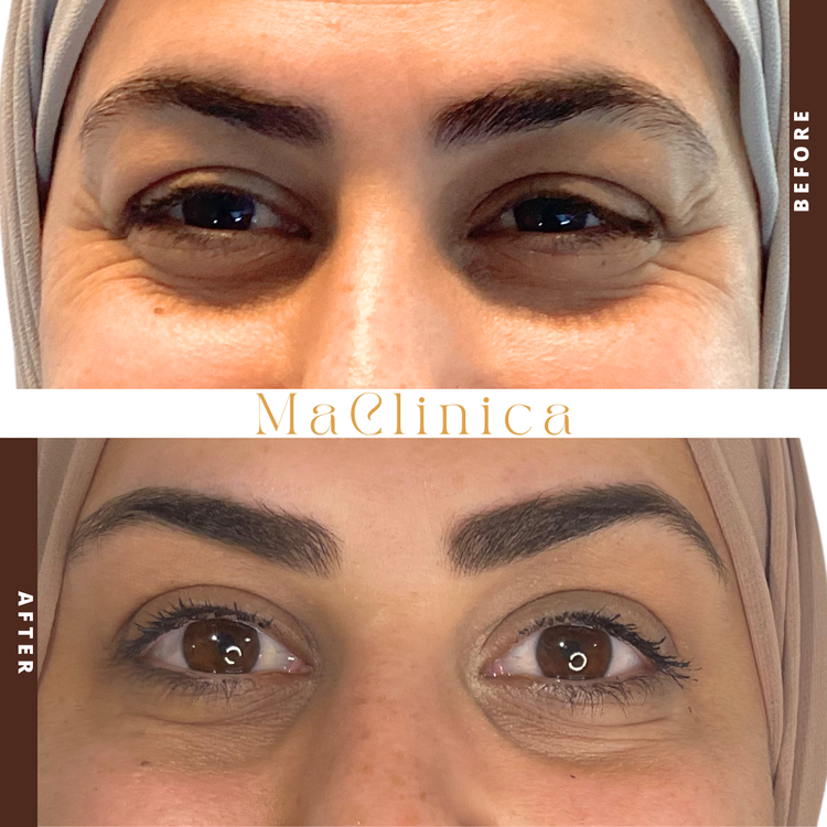MaClinica forehead-lines before-and-after result with BEFORE and AFTER labels and clinic branding
