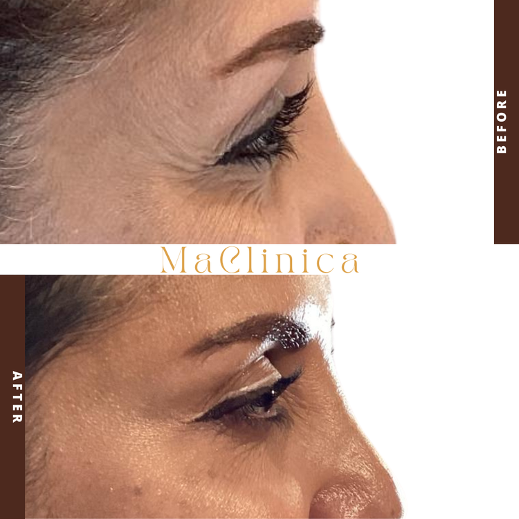MaClinica eye-area before-and-after photograph with labels and branding