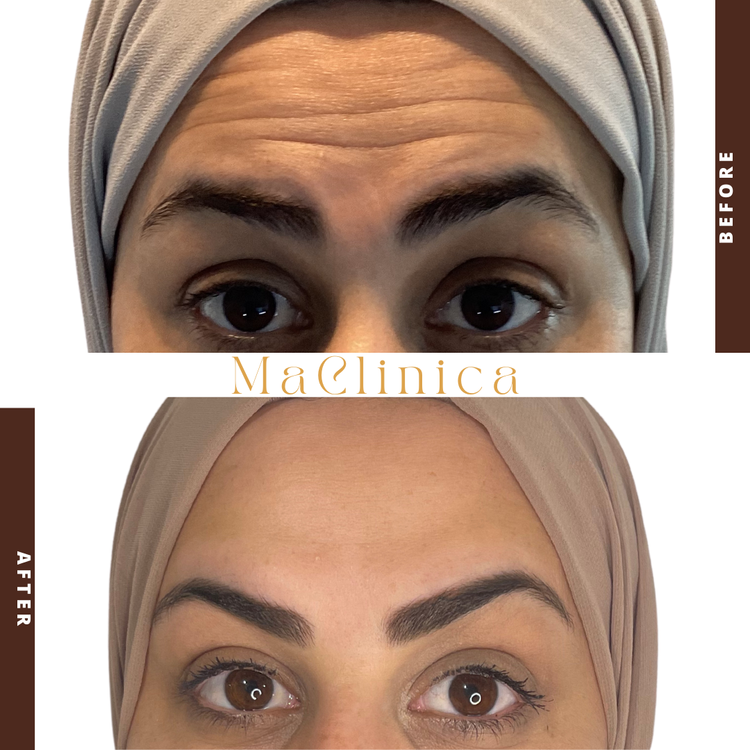 MaClinica crow's-feet before-and-after result with BEFORE and AFTER labels and clinic branding
