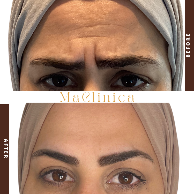 MaClinica frown-lines before-and-after result with BEFORE and AFTER labels and clinic branding