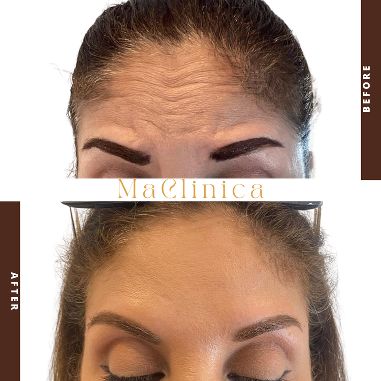 Second MaClinica forehead-lines before-and-after photograph with labels and branding