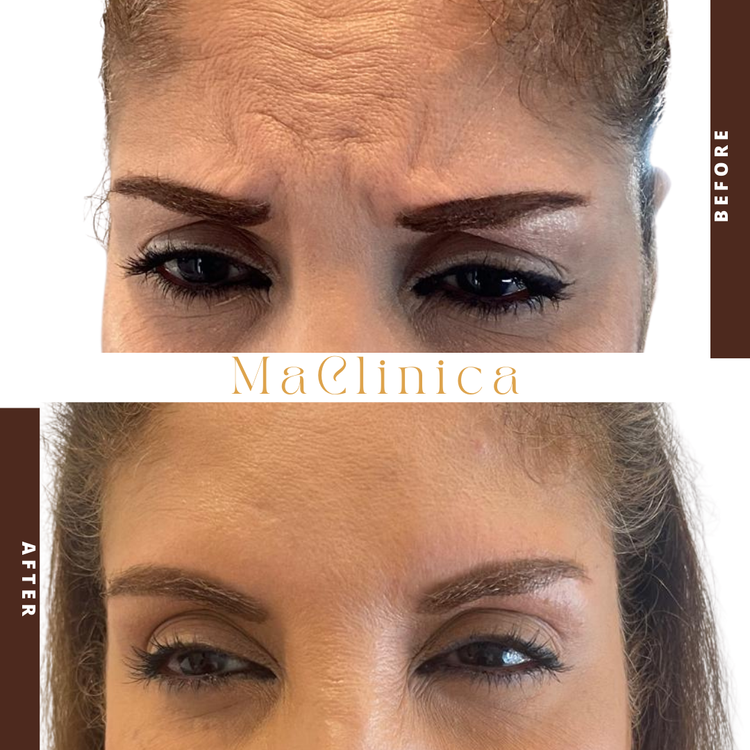 Second MaClinica frown-lines before-and-after photograph with labels and branding